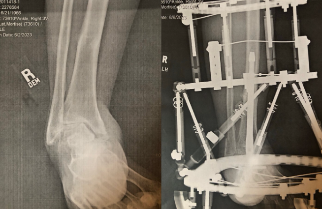 Process of an Ankle Fusion
